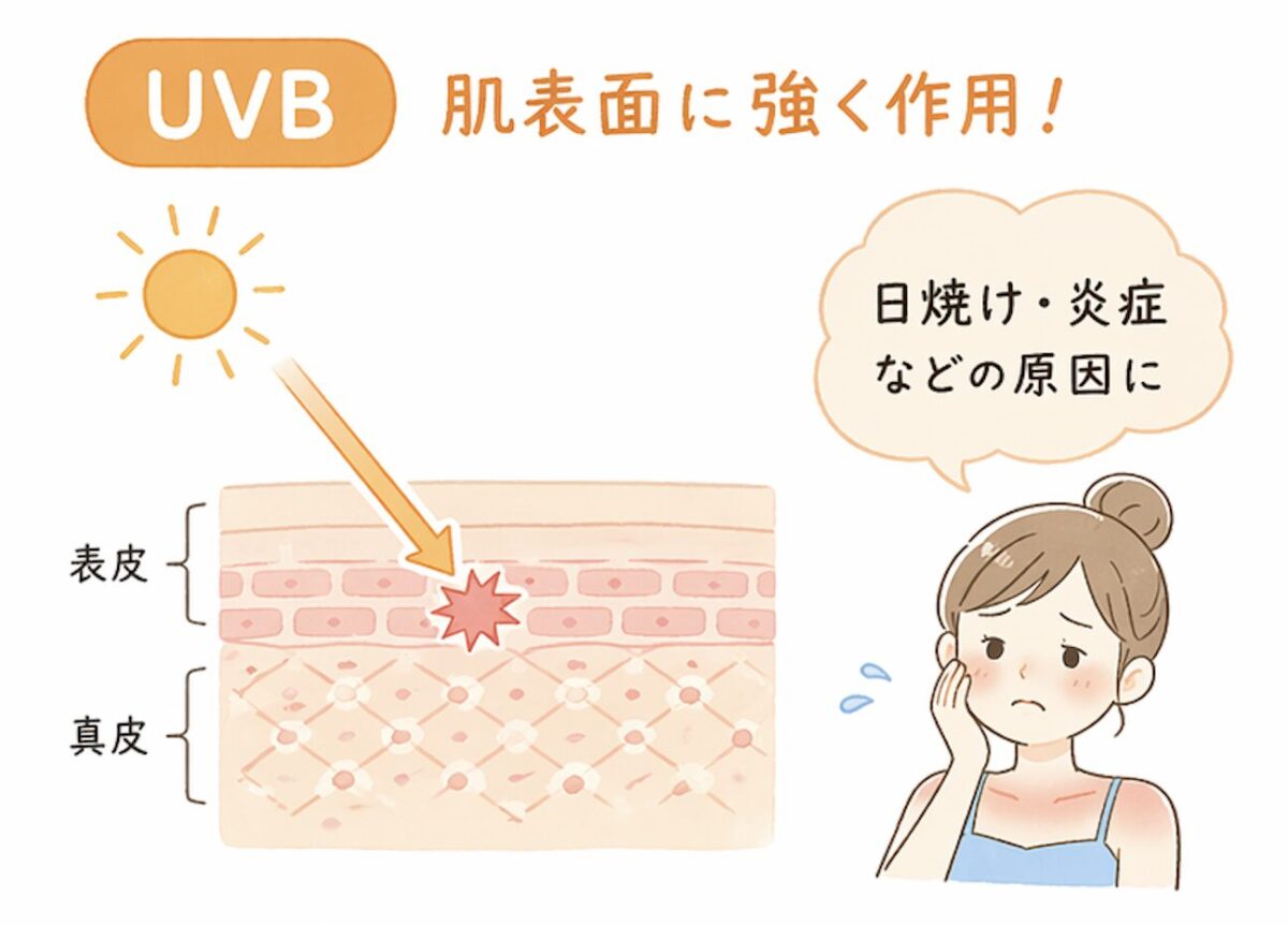 UVB(紫外線B波)が肌表面(表皮)に作用し、日焼けや炎症を引き起こすイラスト
